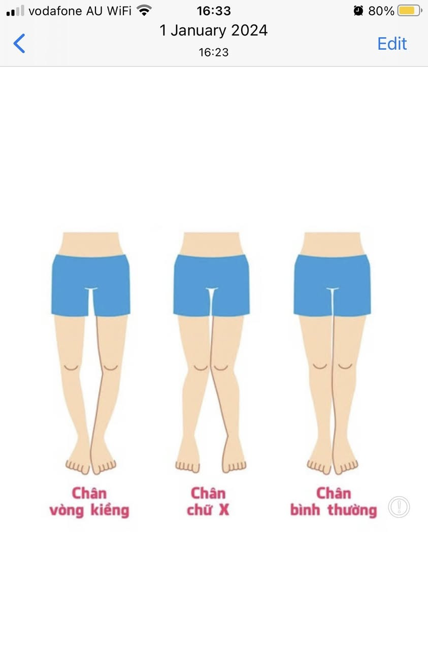 Leg alignment issues - chân vòng kiềng, chân chữ X, chân bình thường